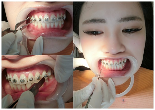 台中牙齒矯正分期-牙醫