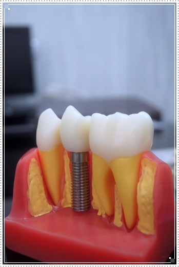 植牙醫師推薦-牙醫診所